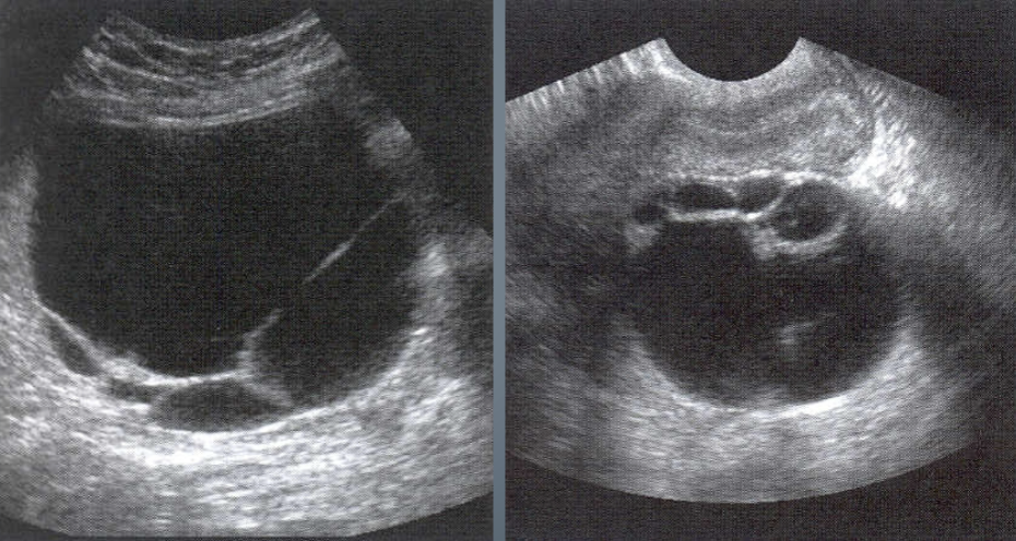 <ul><li><p><span style="color: rgb(255, 0, 0)">Most common type of ovarian cystic tumor</span></p></li><li><p>Seen mostly in <span style="color: rgb(167, 0, 255)">post-menopausal women</span> (<strong>both types</strong>)</p></li><li><p>Contains thin serous fluid</p></li><li><p>Usually unilocular</p></li><li><p>May have <u>thin septations</u></p></li><li><p>May have papillary projections</p></li><li><p>Bilateral - 25% of the time</p></li></ul><p></p>