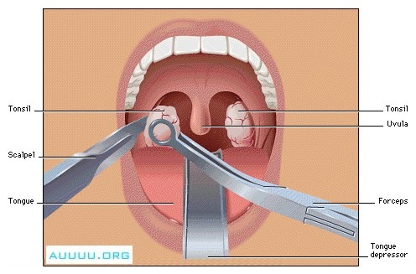 <p>removal</p>