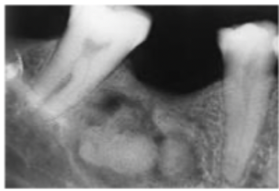 <p>What is this lesion? </p>