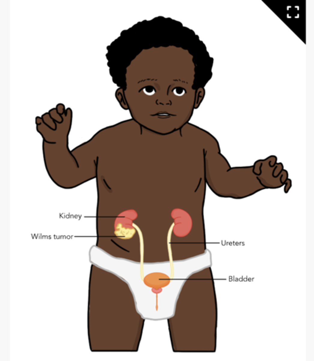<p>also known as nephroblastomata, grow within the kidney</p><p>-may develop in one or both kidneys</p>