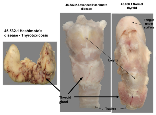 <p>Describe the appearance of specimen 45.532.2, compared to the normal</p>