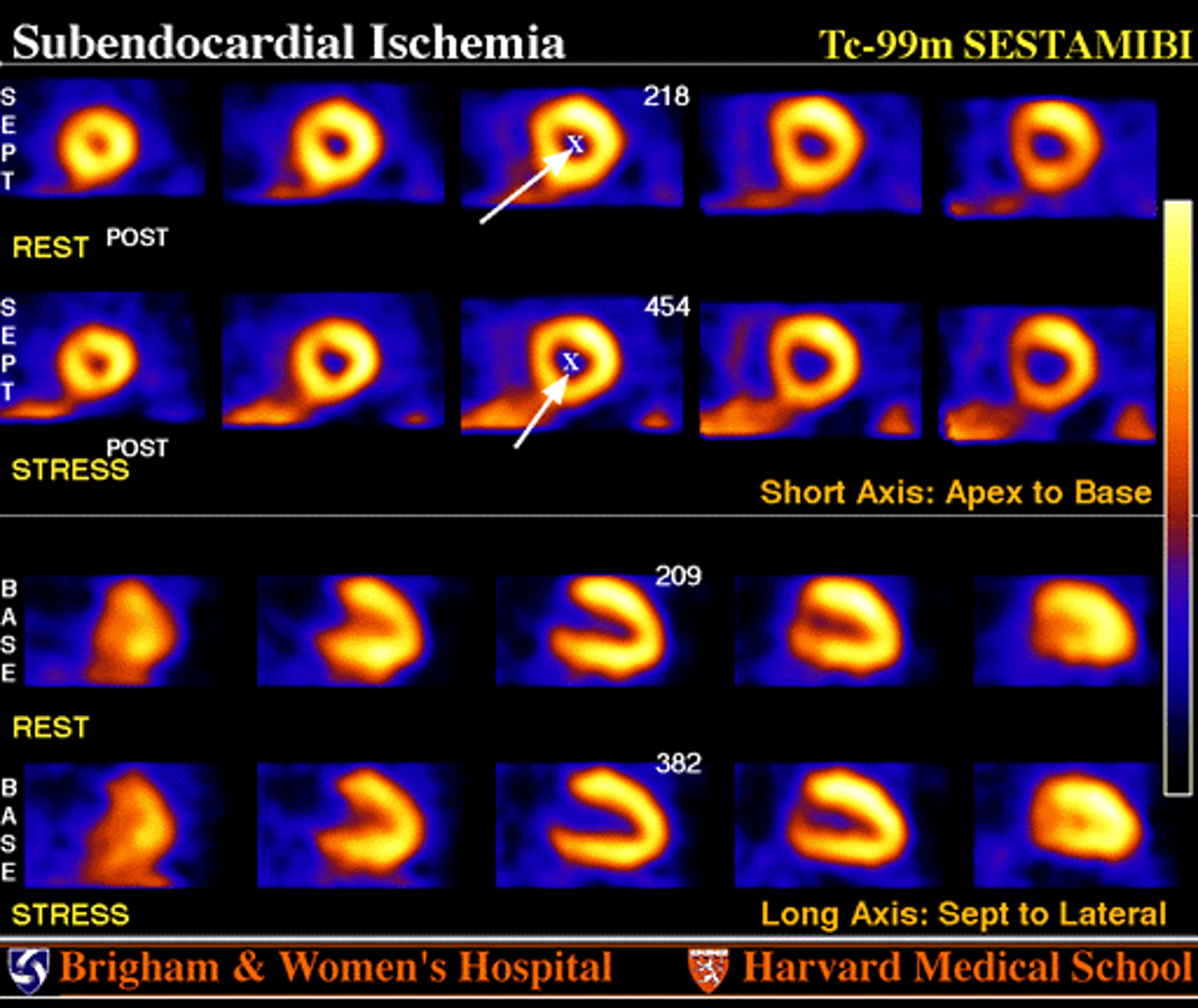 <p>What pharmacologic condition could mimic this finding?</p>
