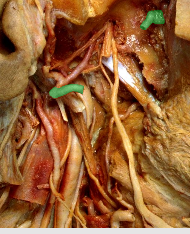 <p>Which artery?(cut)</p>