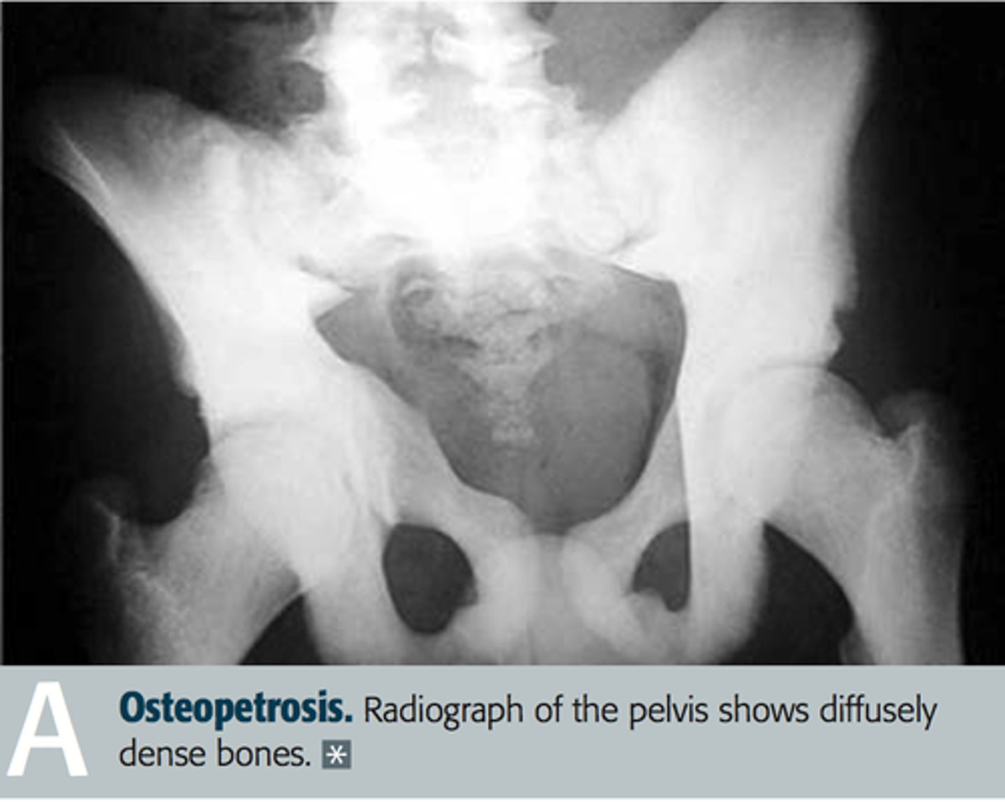 <p>What is osteopetrosis?</p><p>- failure of normal bone resorption due to defective osteoclasts --> thickened, dense bone that are prone to fracture</p><p>- bone fills the marrow space resulting in pancytopenia and extramedullary hematopoiesis</p><p>What mutations can cause it?</p><p>- mutations (carbonic anhydrase II) impair the ability of the osteoclast to generate an acidic environment necessary for bone reabsorption</p><p>Xray findings?</p><p>- bone-in-bone (stone bone) appearance</p><p>Complications?</p><p>- cranial nerve impingement</p><p>- palsies due to narrowed foramina</p><p>- bone marrow transplant is potentially curative as osteoclasts are derived from monocytes</p>