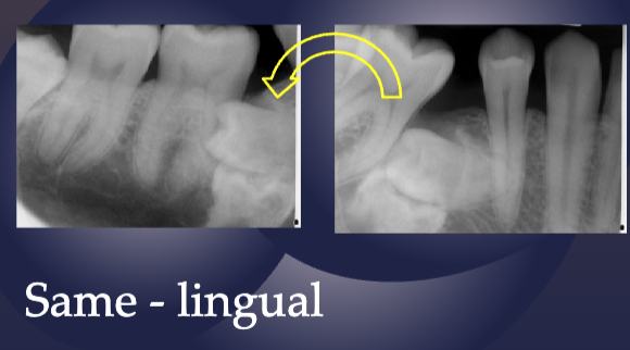 <p>impacted tooth moves distally as tube move (same direction), therefore it is lingual</p>