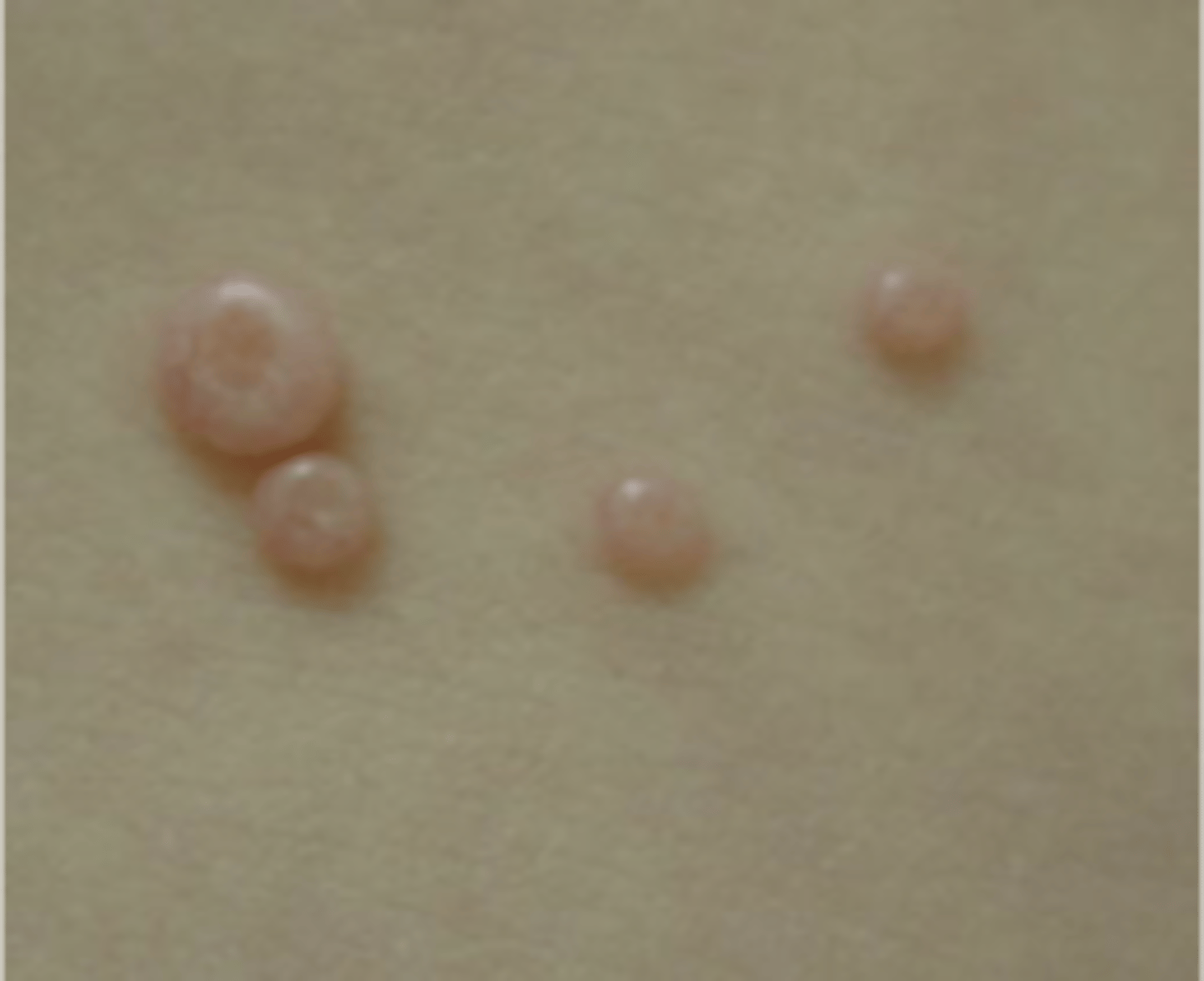 <p>name this skin pathology</p>