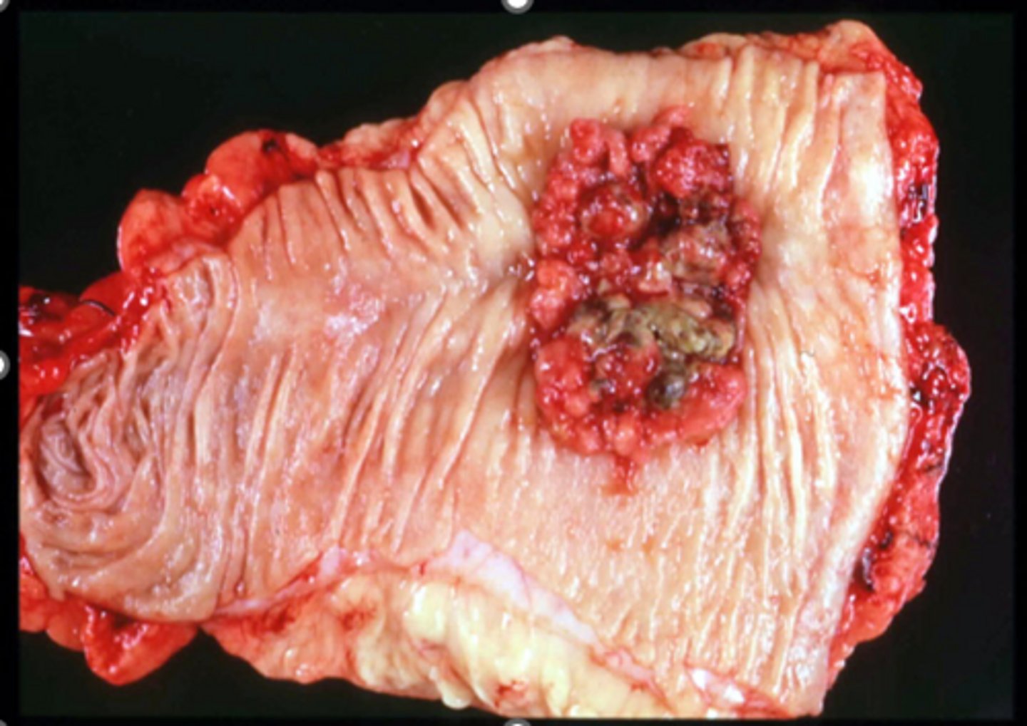 <p>a mass with blood</p>