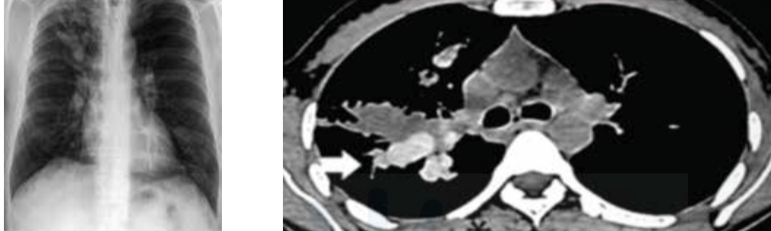 <p>High attenuation mucus inn aspergiiiosis is called</p>