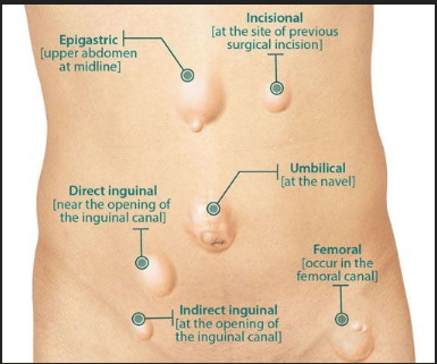 <p>B</p><p>The nurse should explain that a hernia is a protrusion of the abdominal viscera through an abnormal opening in the muscle wall</p>