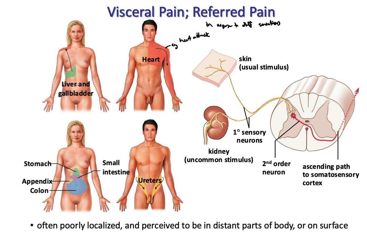 <ul><li><p>uncommon sensory stimuli from visceral organs often propagates down primary neurons and converges onto second order sensory neurons in the spinal cord </p></li><li><p>these second order sensory neurons  also typically obtain info from a usual stimulus (eg. pain on skin)</p></li><li><p>signal goes up to somatosensory cortex and induces same feeling the usual stimulus would</p></li></ul><p>hence why visceral pain is often poorly localized and perceived to be in distant parts of body or on surface</p>