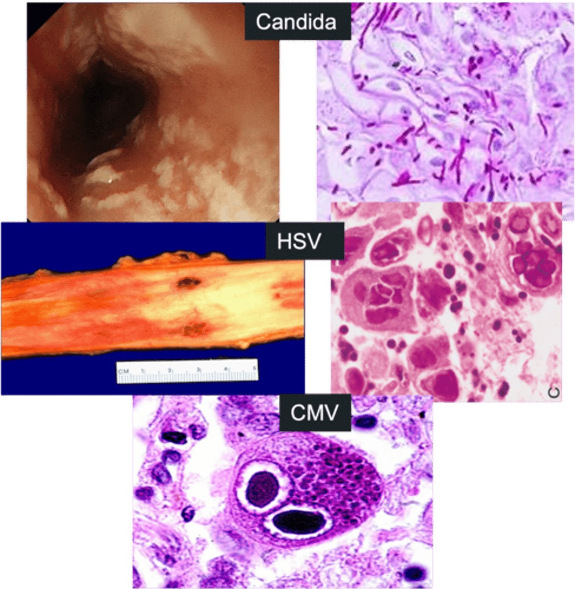 <p>Define Condition:</p><p>Inflammation of esophagus d/t INFECTION; AKA "heart burn</p><p>-Hx:</p><p>&gt; Impaired Host Defenses (HIV. Immunocompromised)</p><p>&gt; Infex</p><p>&gt;&gt; Candida albicans</p><p>&gt;&gt; HSV</p><p>&gt;&gt; CMV</p><p>-Sx:</p><p>&gt; Difficulty swallowing saliva</p><p>&gt; Odynophagia</p><p>&gt; Chest Pain</p><p>-Dx: Endoscopy</p><p>&gt; Candida</p><p>&gt;&gt; White or yellow patches ("cottage cheese")</p><p>&gt;&gt; Fungal pseudohyphae PAS (+)</p><p>&gt; HSV</p><p>&gt;&gt; Ulcers = "Punched Out holes"</p><p>&gt;&gt; Multinucleated squamous cells w/ nuclear inclusions + margination of chromatin + nuclear molding</p><p>&gt; CMV</p><p>&gt;&gt; Linear ulcers</p><p>&gt;&gt; Owl's Eye Inclusions (cytoplasmic &amp; nuclear inclusions w/ peripheral clearing)</p><p>-Tx: Antifungal or Antiviral Drugs</p>