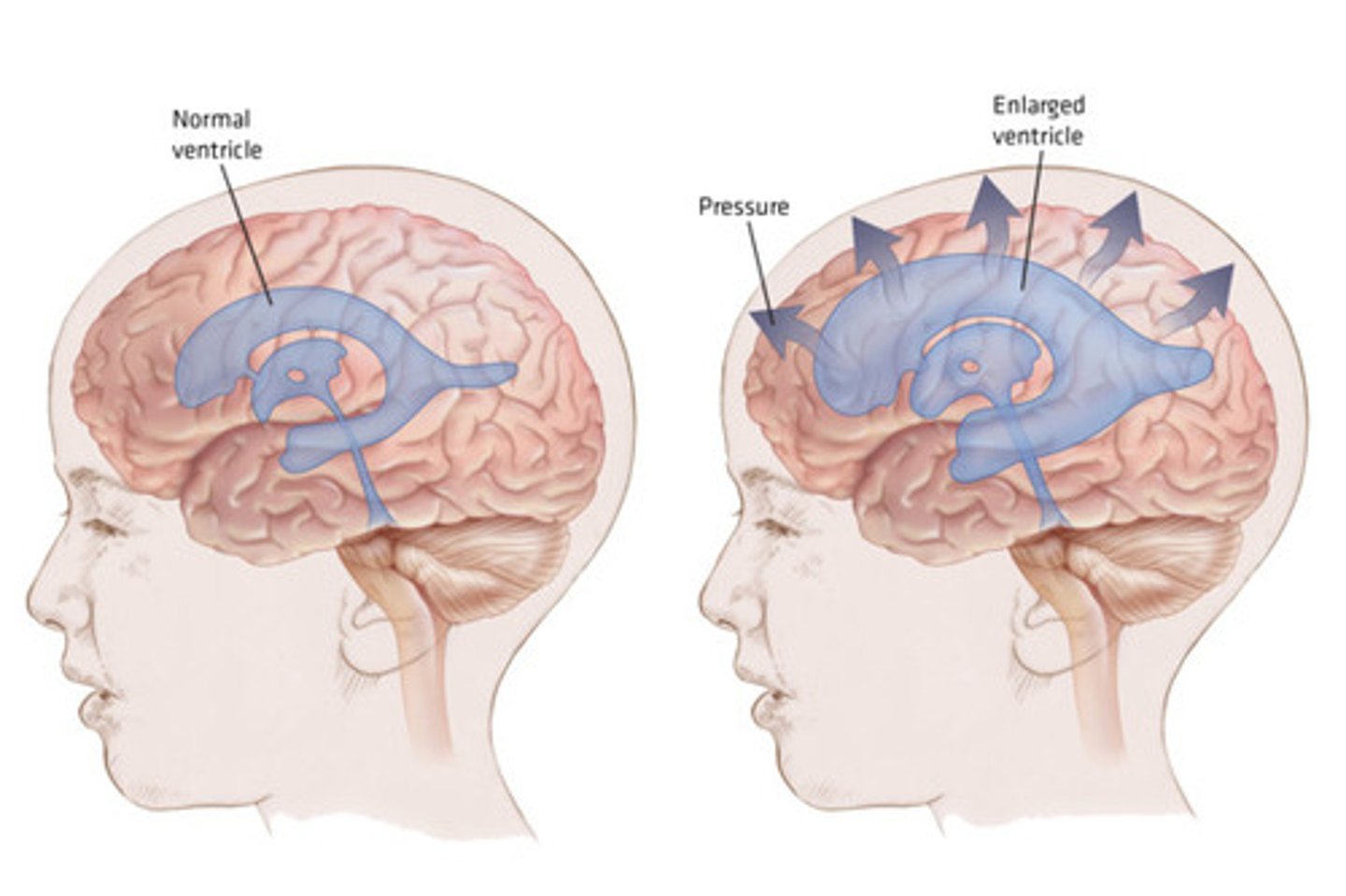 <p>Obstruction of CSF flow</p><p>excessive accumulation of CSF</p><p>Widens the ventricles and puts pressure on surrounding neurological tissue</p><p>Managed with a ventriculoperitoneal shunt- redirect fluid to peritoneal or pleural cavity</p>