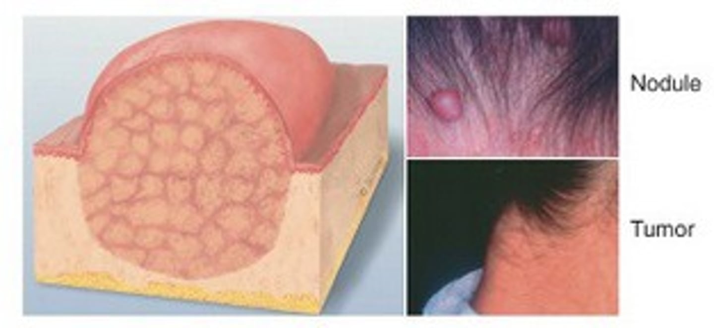 <p>elevated, solid, palpable mass with irregular border- may be malignant (cancerous) or benign ex. tumor</p>