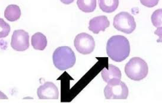 <ul><li><p>RBC’s with blueish tint</p></li><li><p>organelles remain in cytoplasm</p></li><li><p>indicate young RBC’s</p></li><li><p>appear as reticulocytes when stained with NMB</p></li></ul><p></p>