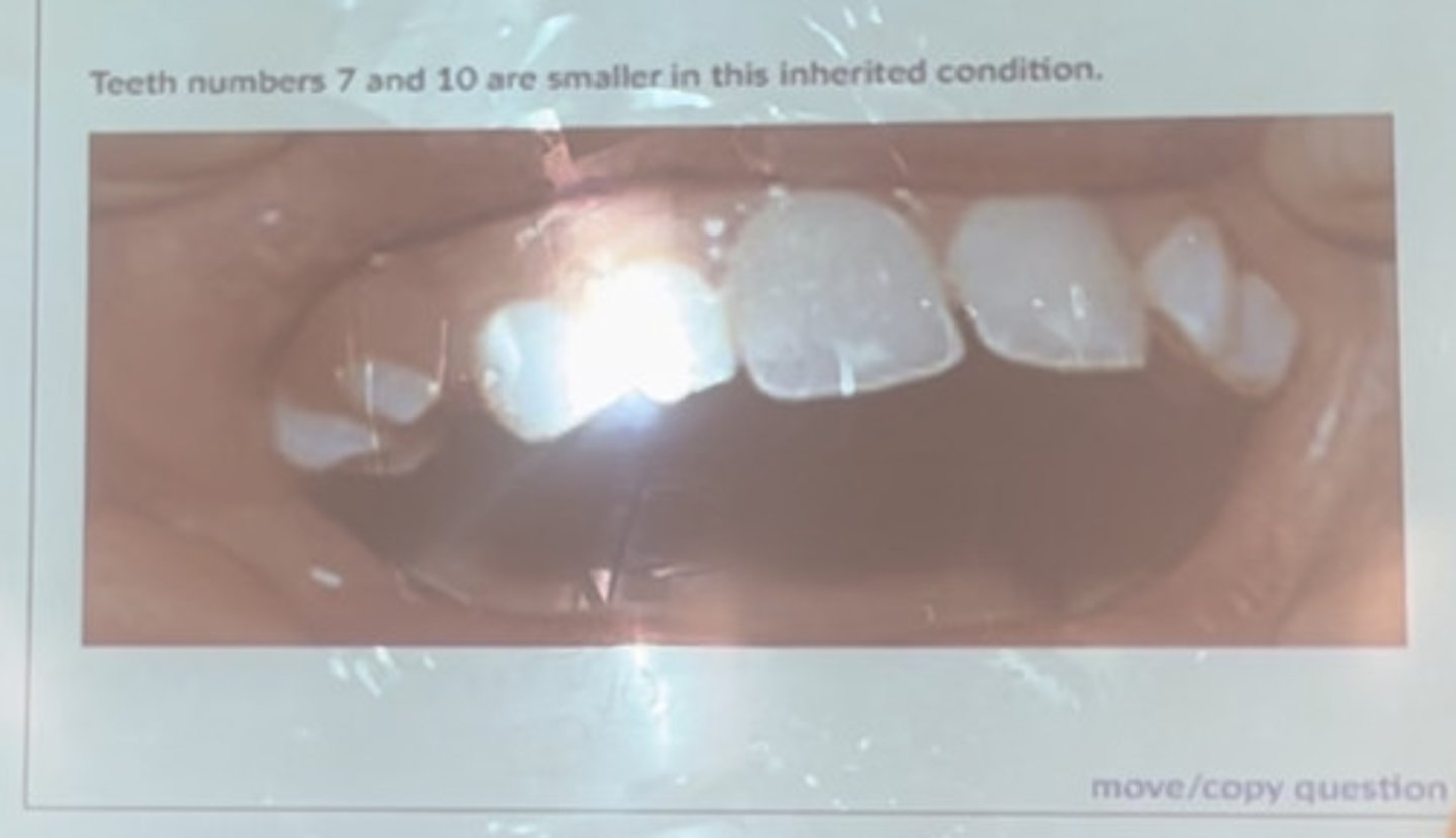 <p>Teeth numbers 7 and 10 are smaller in this inherited condition.</p>