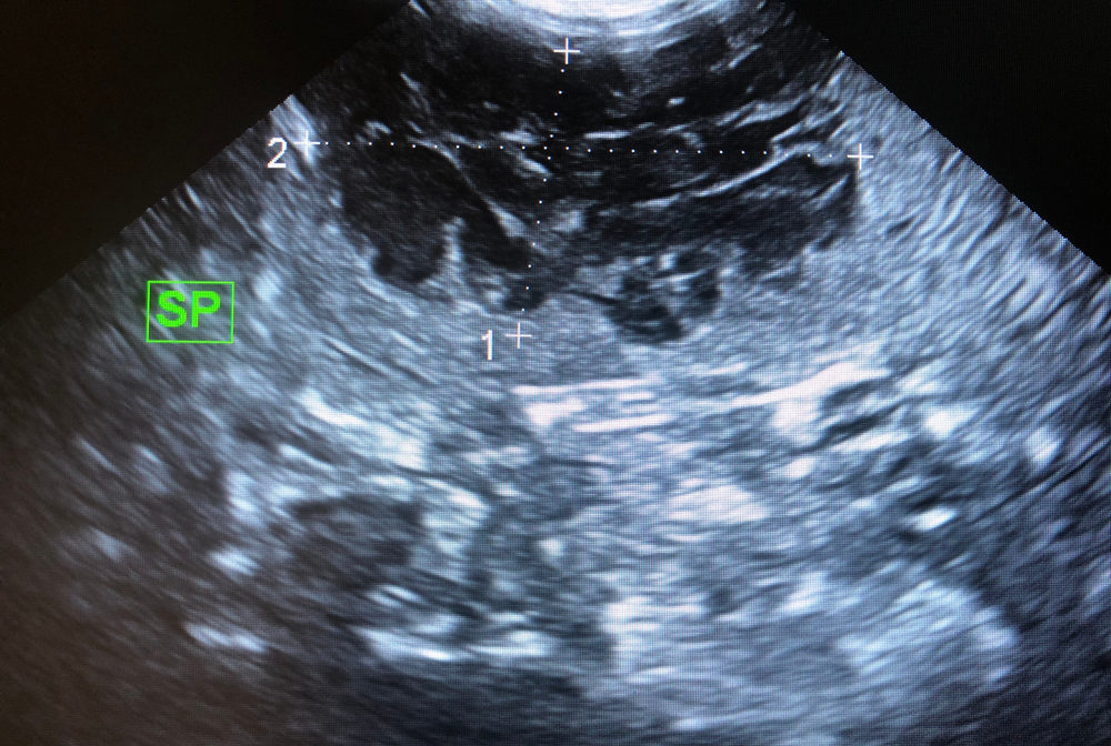 <p>X-ray and USG (showing fluid-filled cavities).</p>