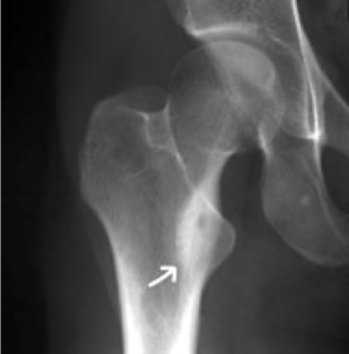 <p>_____ of osteoid osteoma occurs in the tibia or femur</p>