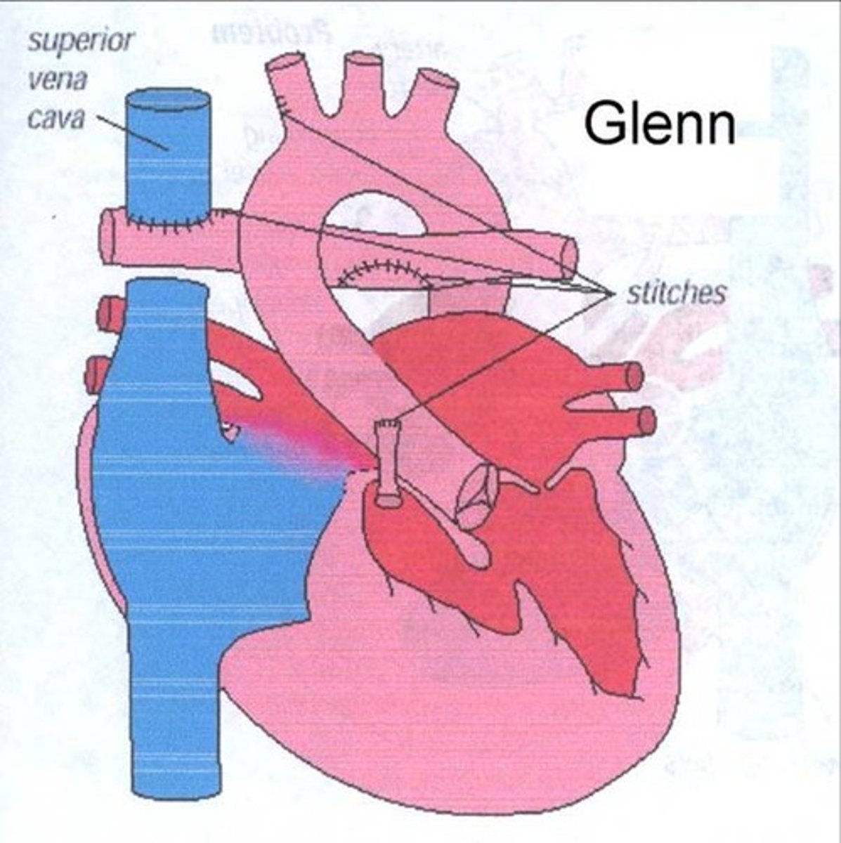 <p>STAGE 2</p><p>(Bidirectional Glenn — ~4 months)</p><p>• Goals: Permanent pulmonary flow for upper body; free RV for systemic pumping</p><p>• Sano shunt TAKEN DOWN</p><p>• Superior Vena Cava (SVC) redirected DIRECTLY to pulmonary artery — bypasses right atrium</p><p>• IVC remains flowing to right atrium as before</p><p>• Result: Upper body blood → SVC → directly to lungs (passive)</p><p>• Lower body blood → IVC → RA → mixes with oxygenated blood via ASD → RV → aorta</p><p>• Oxygen saturations in the 80s is TARGET/expected at this stage</p>