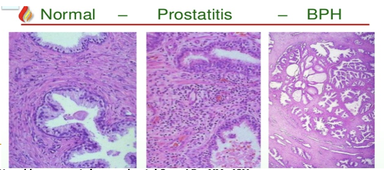 <p>benign prostate hyperplasia</p>