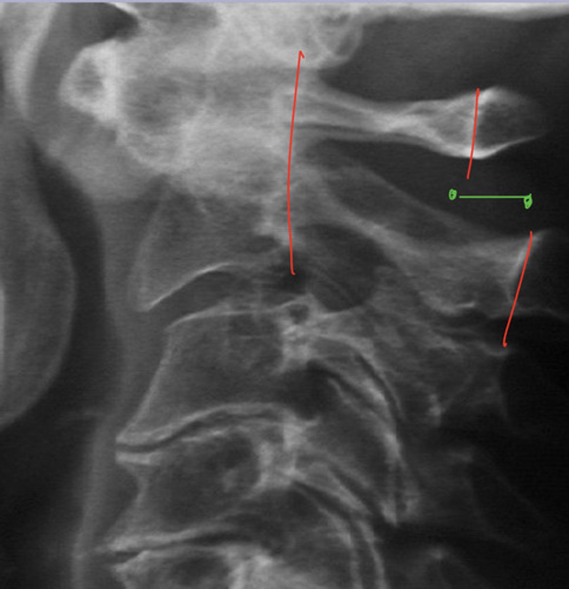 <p>What may cause a widened anterior ADI due to erosions?</p>