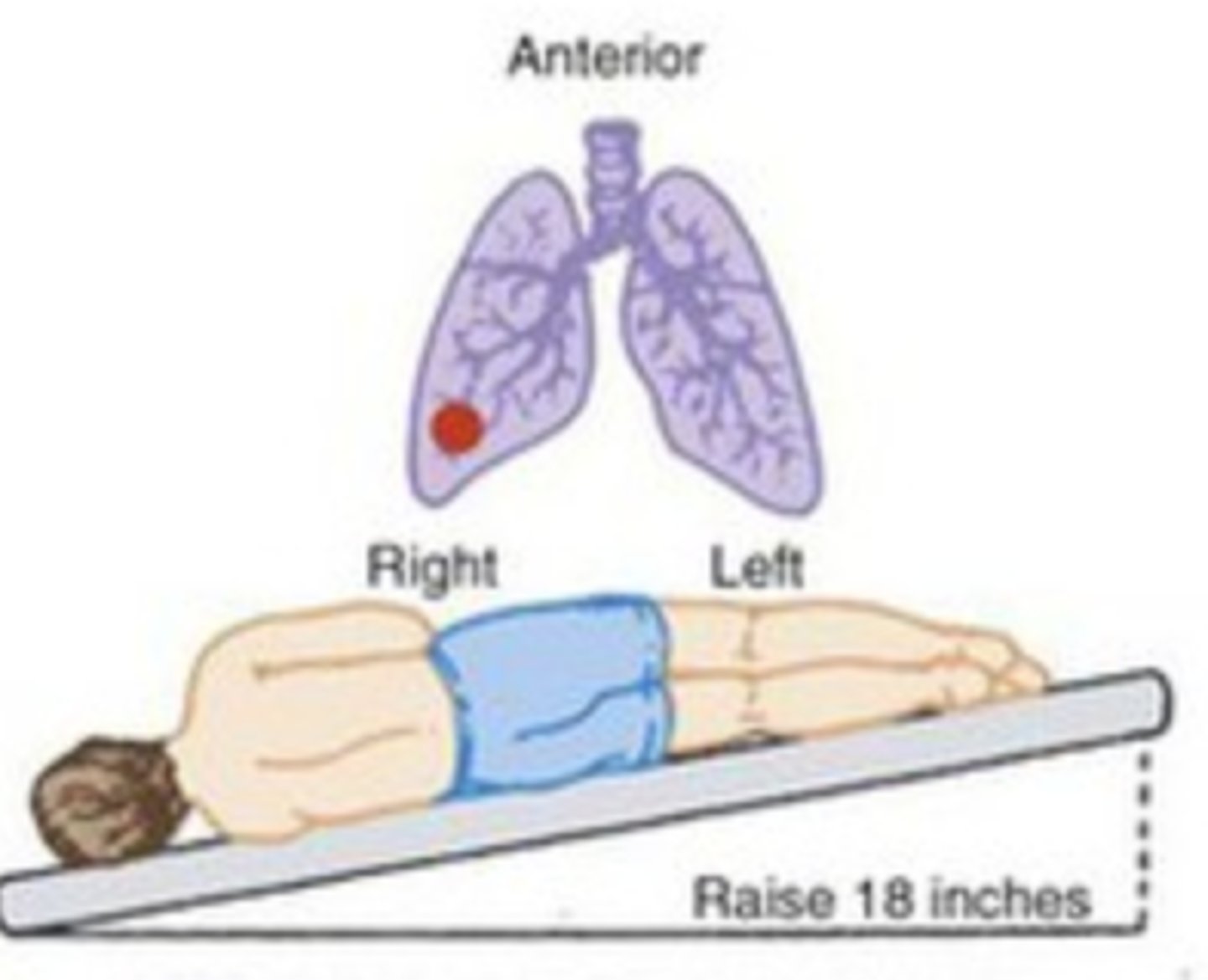 <p>- Position the patient on the left side with the foot of the bed elevated 18 to 20 inches</p><p>- Percuss over the lower ribs</p>