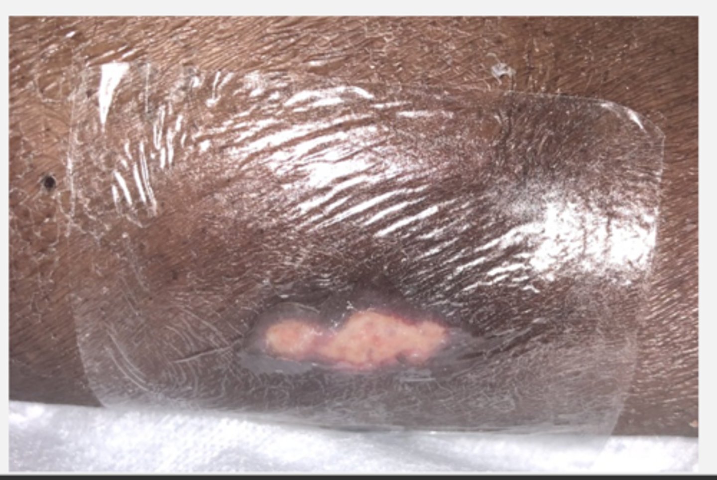 <p>d. Thin film dressing.</p><p>Thin film dressings are used on Stage I ulcers to protect them from shearing forces and to keep them moist.</p>