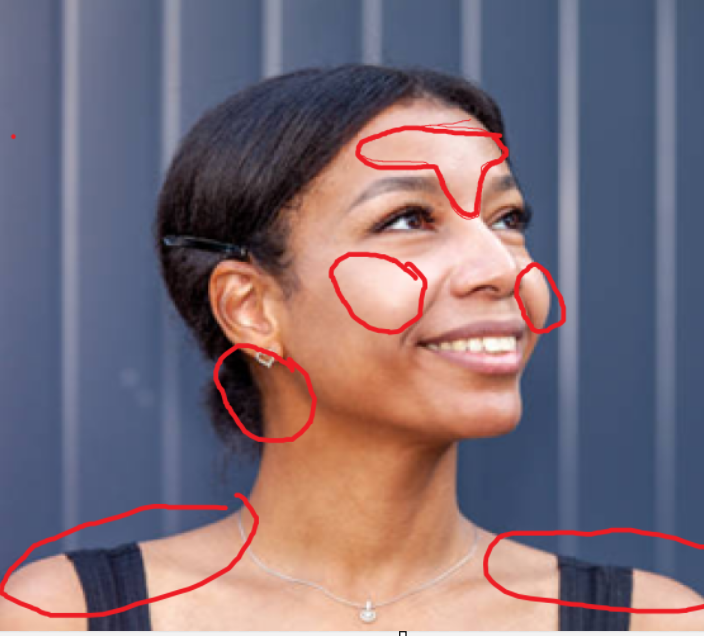 <p>Sun exposed areas, specially in the H&N:</p><ol><li><p>T-Zone</p></li><li><p>Cheeks</p></li><li><p>Back of ears</p></li><li><p>Shoulders</p></li></ol><p></p>