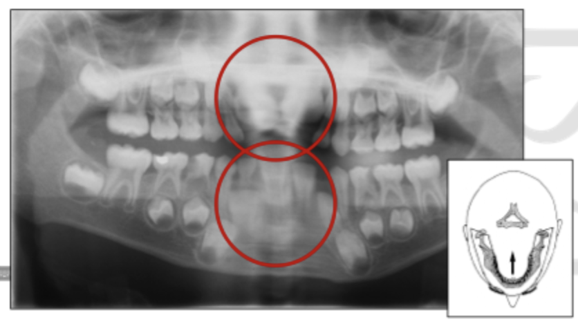 <p>Patient position - Antero-posterior error</p>