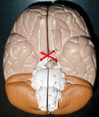 The crossing of the optic nerves from the two eyes at the base of the brain; a point in the brain where half the visual information from each eye crosses over into the opposite hemisphere