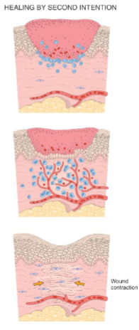 <p>2nd intention is for a Large tissue defect with more intense inflammation, granulation (leads to scar) & wound contraction</p><p>For 2nd intention, regeneration of parenchymal cells alone cannot restore the tissue</p>