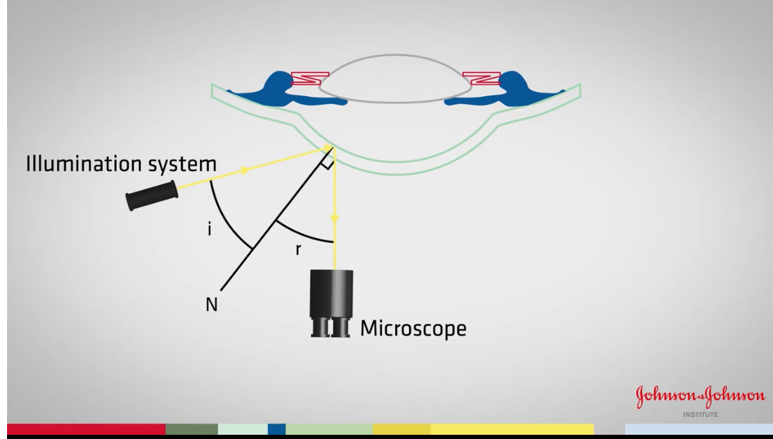 <p>Need to observe the reflection of the illumination systems light source </p><p>Reflected ray should make an angle to the normal </p><p>Should be equal to the angle Of incidence </p><p>As cornea is curved, the normal will change across surface </p>