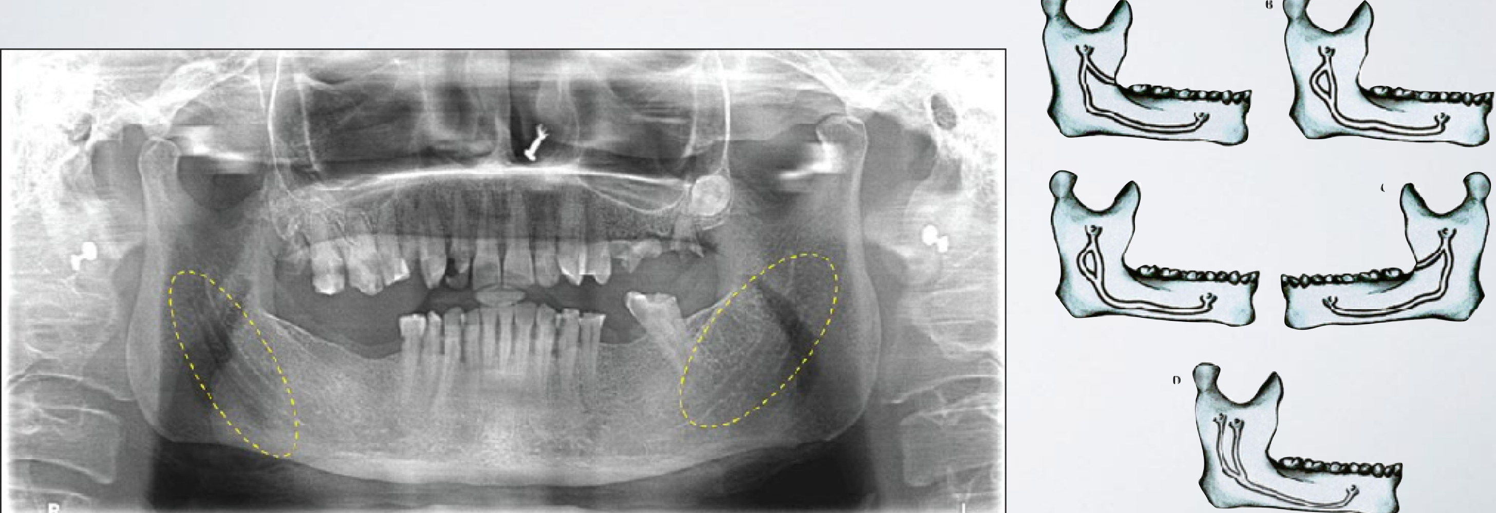 <ul><li><p>A second mandibular foramen may exist</p></li><li><p>To correct: second injection inferior to the normal anatomical landmark</p></li></ul><p></p>
