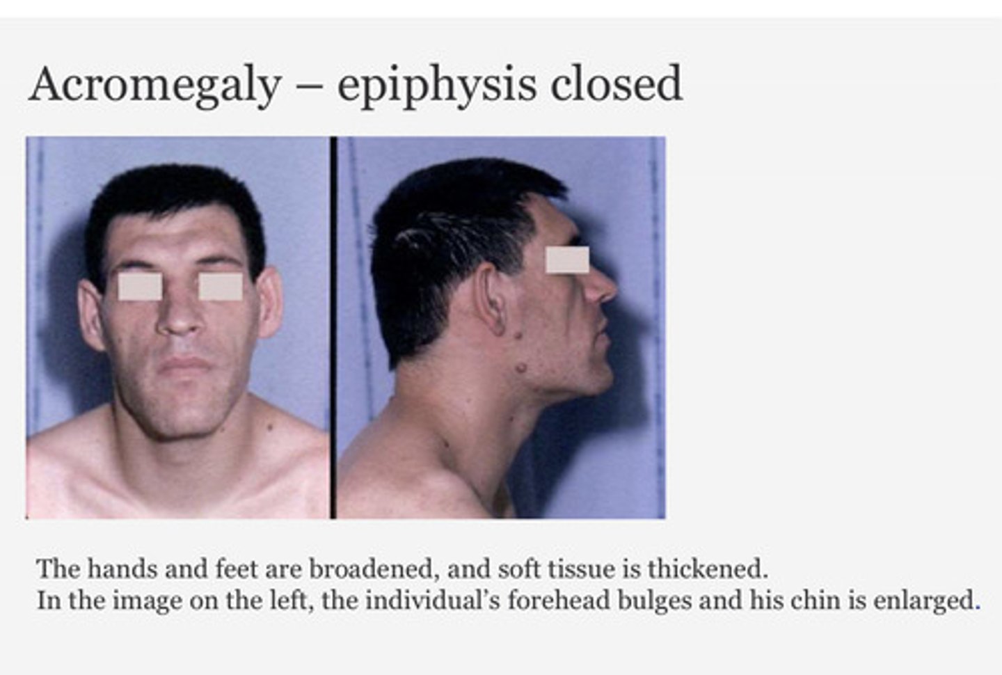 <p>Rare condition resulting from excess secretion of growth hormone (GH).</p><p>Acromegaly is the condition that results when there is excess GH AFTER puberty (when the epiphyseal growth plates close).</p>