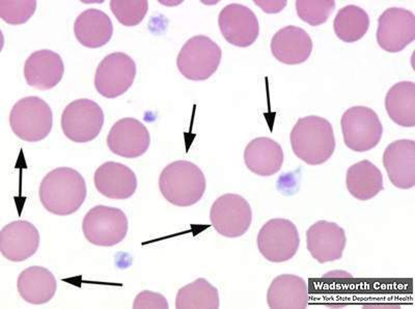 <p>RBC spheres containing more than normal amounts of hgb</p><p>seen in:</p><p>- AIHA</p><p>-- Ab-mediated hemolysis</p><p>- DIC</p><p>- hereditary spherocytosis (defect in spectrin)</p><p>- some infections (lecithinase bacteria like C. perfringens)</p><p>-- lecithin is apart of RBC membrane</p><p>treatment: splenectomy</p>