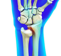 <p>Ulnar Head + Ulnar Notch of Radius</p><p></p><p>Pivot</p><p></p><p>Supination / Pronation</p>