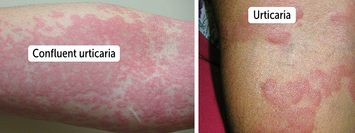 <p><span>urticarial wheals appear as well-circumscribed, <strong>raised, erythematous plaques</strong> with areas of <strong>central </strong></span><strong><u>pallor</u></strong></p><ul><li><p>Lesions are <strong>edematous and blanching</strong></p></li><li><p>Lesions last about 24 hours and any part of body is impacted</p></li><li><p>From several mm to greater than 5 cm</p></li><li><p>Urticaria can be isolated, but can precede serious allergic reactions like <strong>anaphylaxis</strong></p></li></ul><p></p>