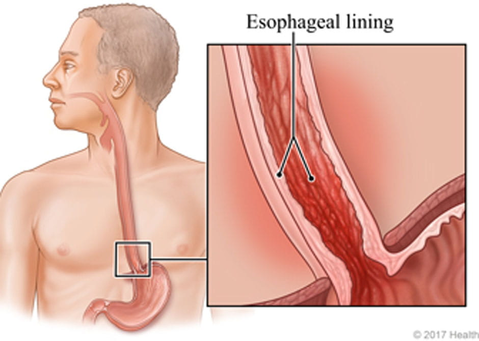 <p>pain in the <strong>substernal area</strong> that is severe and constant</p>