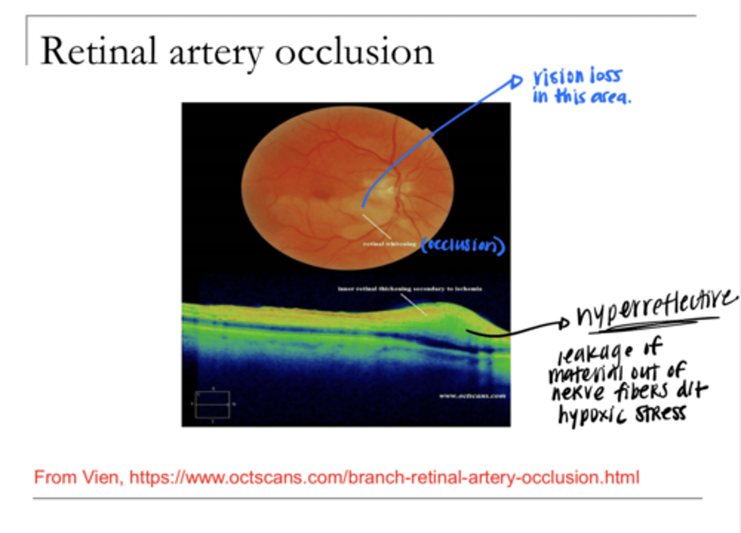 <p>Retinal Artery Occlusion may result in inner retinal thickening on OCT secondary to ischemia. What will be the appearance of this?</p>