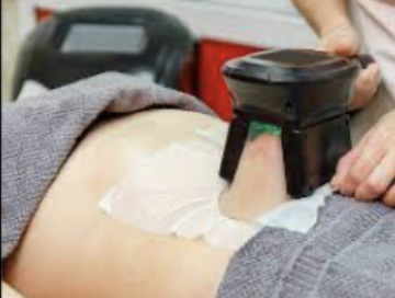 <p>Treatment for unwanted fat deposits; cold device applied to the skin freezes fat cells and causes them to crystalize and die.</p>