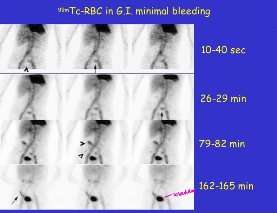 <p>99mTc-RBC- radioactive labeled RBCs that can be used to visualize the source of a GI bleed </p>
