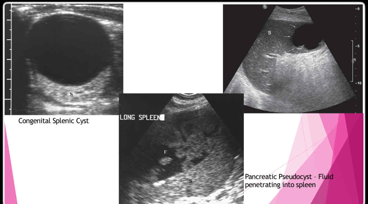 <p>What does the following describe?</p><p>•Polycystic kidney disease lymphangioma,</p><p>•extension of pancreatic pseudocyst</p><p>-Erode into spleen due to proximity</p><p>-May weaken vessels causing pseudoaneurysms and bleeding into pseudocyst</p>