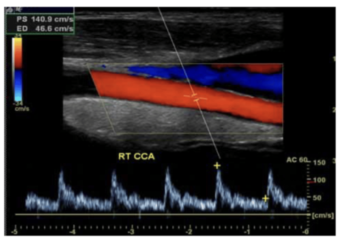 <p>contrast angiography - invasive and carries risk of harm to pt</p><p>duplex u/s is first line study for vascular dz. can eval anatomy plus direction and magnitude of flow</p>