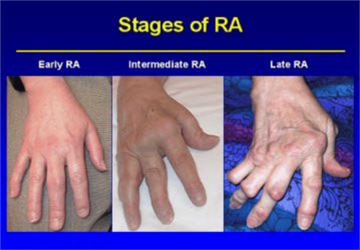 <p>edema</p><p>no deformity</p>