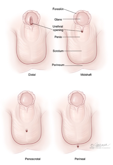 <p>Hypospadias</p>