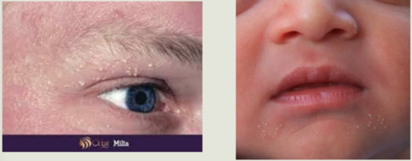 <p>superficial white bumps = external layers of stratified squamous epithelium with keratin core</p>