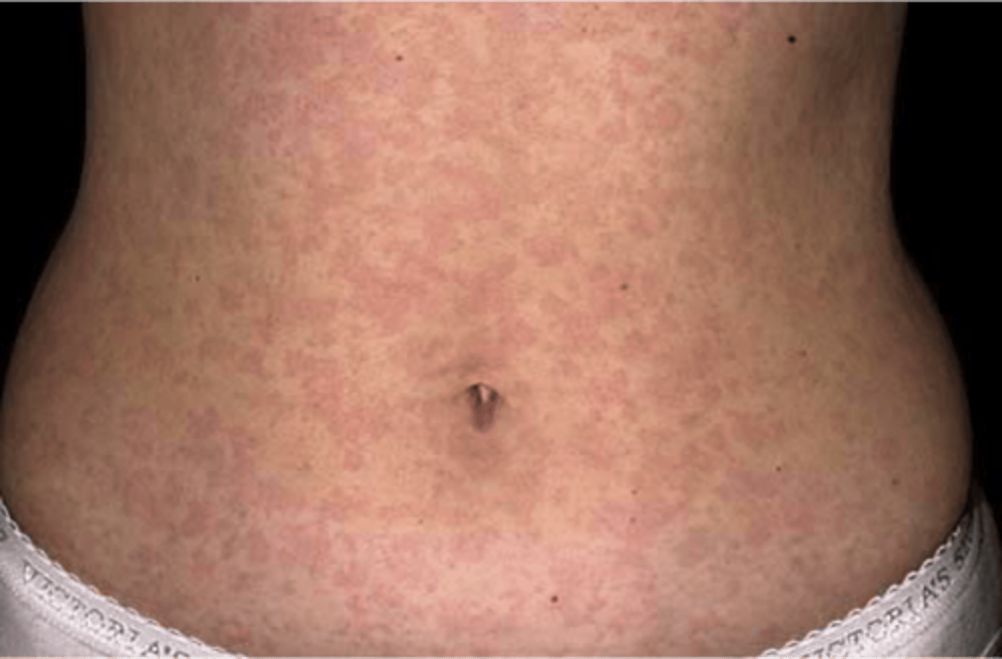 <p>A Drug prescribed for a condition secondary to primary disease until that disease resolves. (corticosteroid to treat allergic rash.)</p>