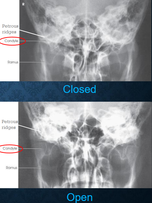 <ul><li><p>mandibular condyles and fossae of the temportal bones</p></li><li><p>no rotation of head</p></li><li><p>closed mouth: minimal superimposition of petrosa on the condyle</p></li><li><p>open mouth: condyle and TMJ below pars petrosa</p></li></ul><p></p>