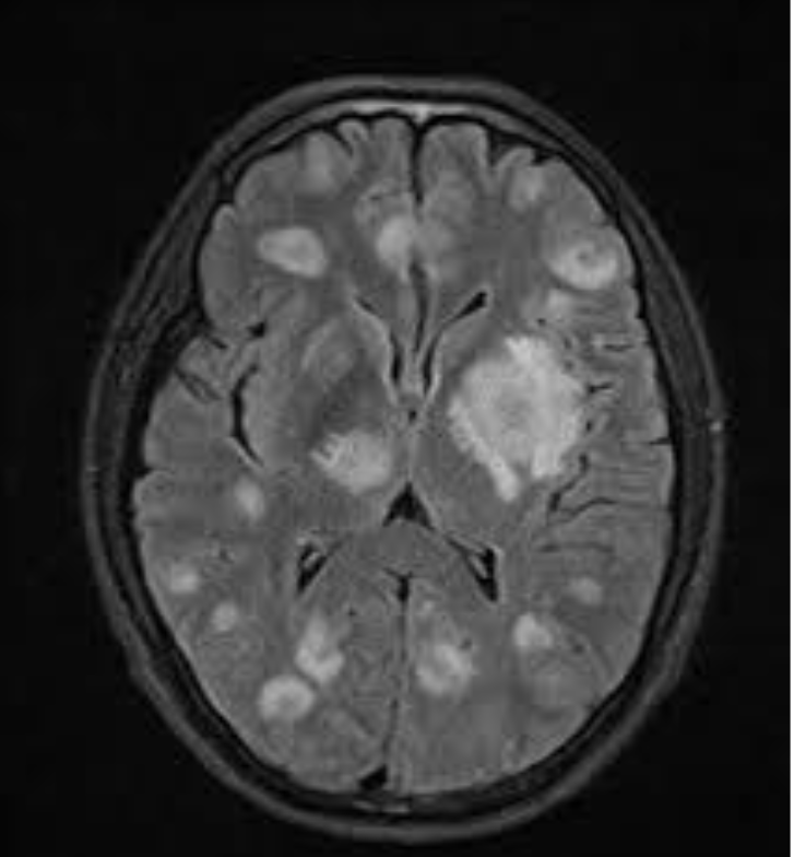 <ul><li><p>due to Toxoplasma Gondii ToRCH infection</p></li><li><p><span style="font-size: calc(var(--scale-factor)*18.02px)">Presents during teens or 20s. (Thought to be reactivation latent tissue cysts)</span></p></li><li><p><span style="font-size: calc(var(--scale-factor)*18.02px)">Accounts for 25% of all granulomatous uveitis in the U.S</span></p></li></ul><p></p>