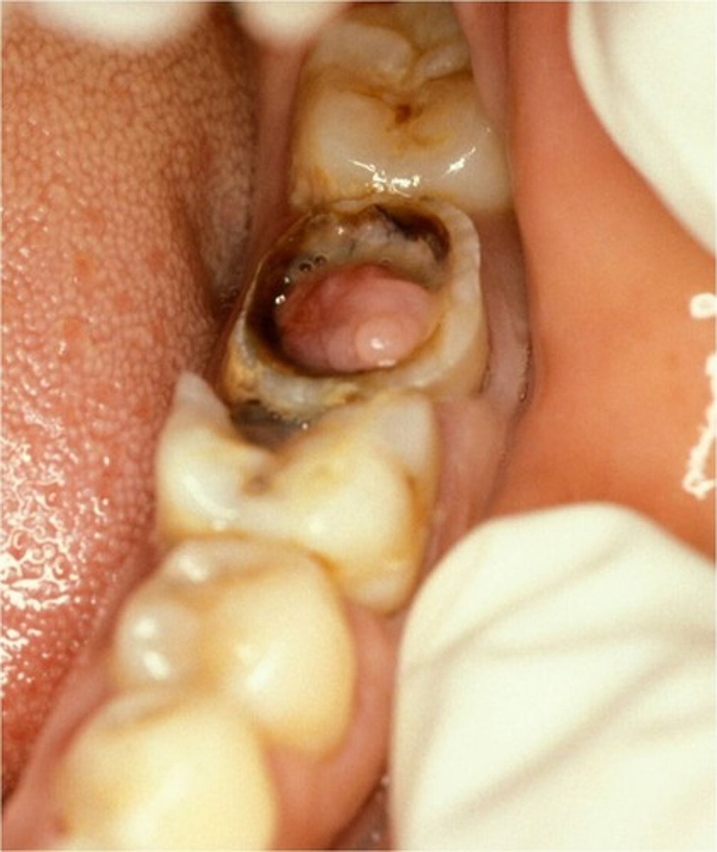 <p>Inflamed pulp tissue within a tooth that is severely decayed or has a large open carious lesion.</p><p>Painless</p>