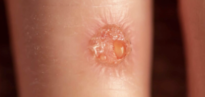 <p><strong>Clear straw colored exudate, thin and watery</strong></p><p>-<strong>normal</strong>, possibly sign of infection</p>